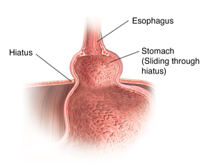 Cross section of stomach, esophagus, and diaphragm showing a sliding hiatal hernia.