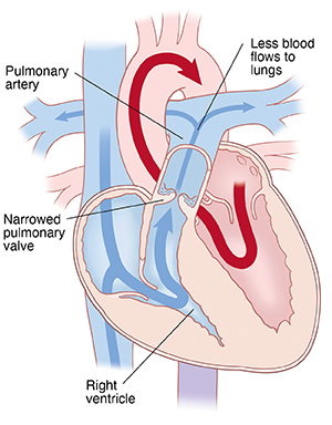 Four-chamber view of heart showing pulmonary stenosis, with arrows to indicate less blood flowing through pulmonary valve.