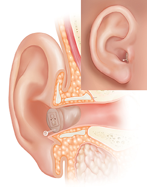 Cross section of ear showing outer ear structures with completely-in-canal hearing aid in place an inset of external view.