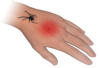 Black Widow spider bite