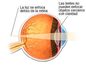 Corte transversal de un ojo donde puede verse la luz que se enfoca detrás de la retina.